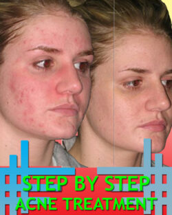 Step By Step Acne Treatment