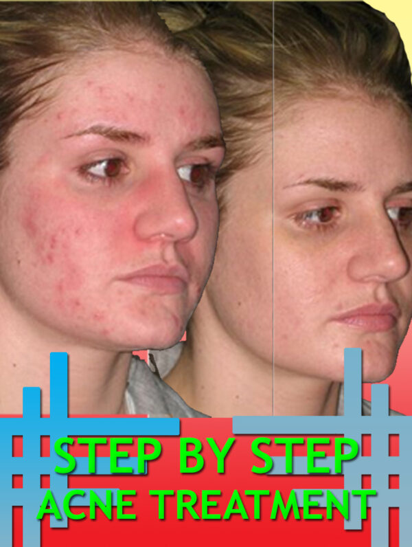 Step By Step Acne Treatment